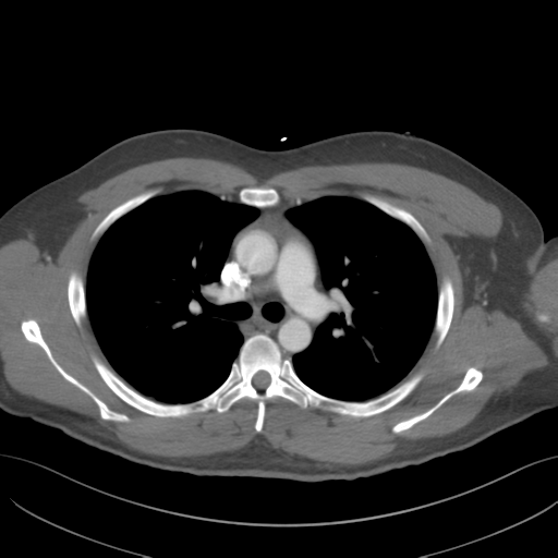 File:Normal CTA thorax (non ECG gated) (Radiopaedia 41750-44704 A 39).png