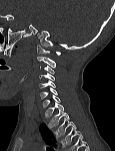 Normal CT cervical spine - pediatric (Radiopaedia 52549-58462 Sagittal bone window 53).jpg