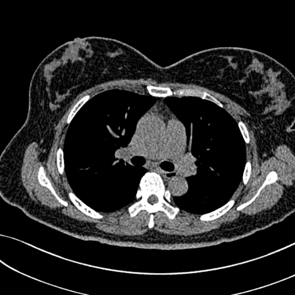 Normal CT chest- adult female (Radiopaedia 52522-58428 Axial non-contrast 56).jpg