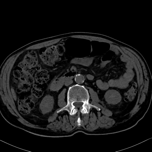 File:Normal CT intravenous cholangiogram (Radiopaedia 38199-40208 Axial IVC 58).png