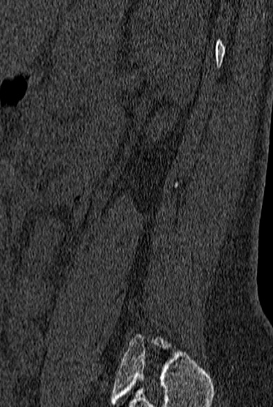 File:Normal CT lumbar spine (Radiopaedia 53981-60118 Sagittal bone window 86).jpg