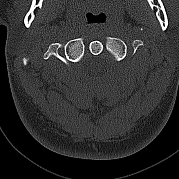 File:Normal CT of the cervical spine (Radiopaedia 53322-59305 Axial bone window 66).jpg