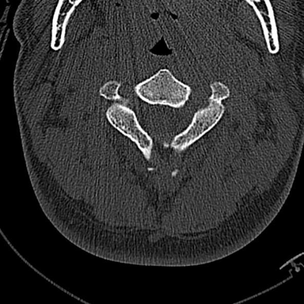 Normal CT of the cervical spine (Radiopaedia 53322-59305 Axial bone window 91).jpg