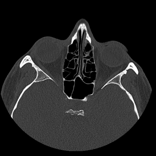 Normal CT paranasal sinuses (Radiopaedia 42286-45390 Axial bone window 49).jpg