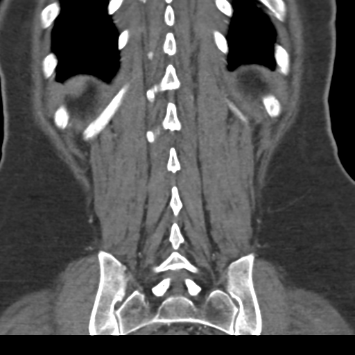 File:Normal CT renal artery angiogram (Radiopaedia 38727-40889 B 64).png