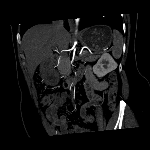 File:Normal CT renal artery angiogram (Radiopaedia 38727-40889 C 8).png