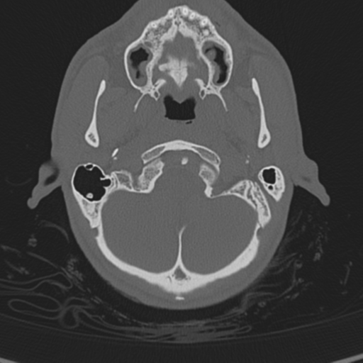 Normal CT skull (Radiopaedia 40798-43459 A 17).png