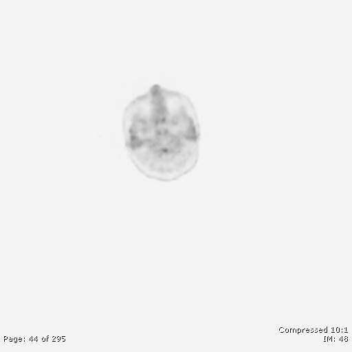 File:Normal F-18 FDG PET-CT (Radiopaedia 77382-89510 C 44).jpg