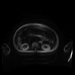 Normal MRI abdomen in pregnancy (Radiopaedia 88001-104541 Axial DWI 117).jpg