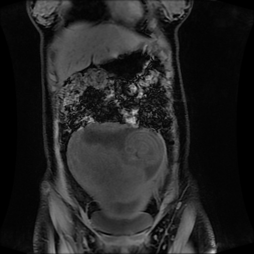 Normal MRI abdomen in pregnancy (Radiopaedia 88001-104541 M 42).jpg