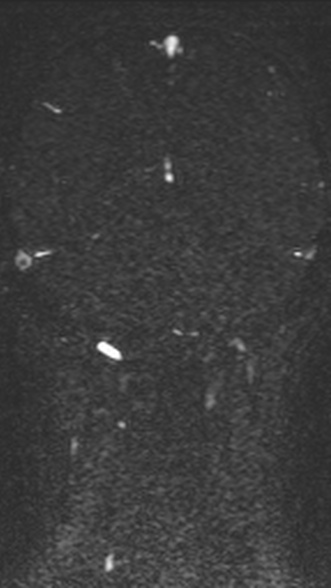 Normal MRI brain with MRV- teenager (Radiopaedia 49425-54553 Coronal MRV 177).jpg