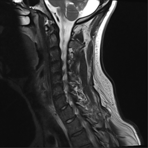 File:Normal MRI cervical spine (infection protocol) (Radiopaedia 53916-60039 Sagittal T2 11).png