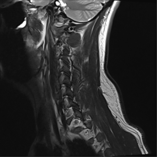 File:Normal MRI cervical spine (infection protocol) (Radiopaedia 53916-60039 Sagittal T2 2).png