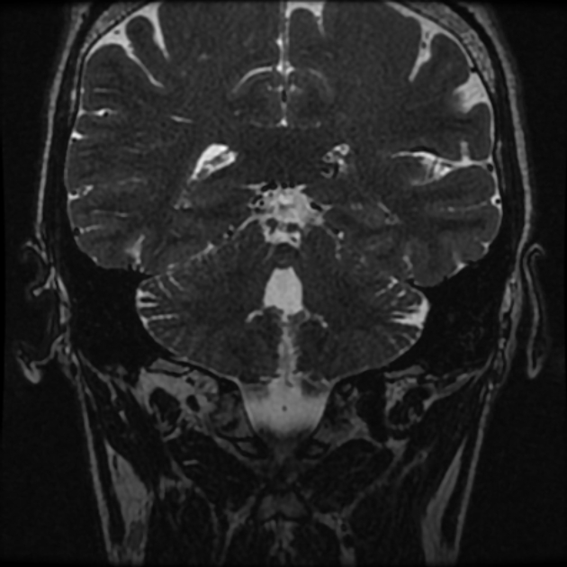 Normal MRI petrous (Radiopaedia 91317-108949 Coronal T2 83).jpg