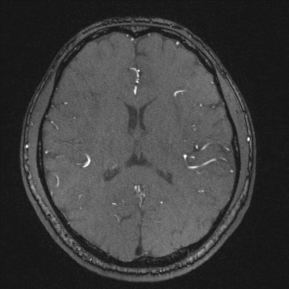 Normal brain MRI including MRA (Radiopaedia 48748-53763 Axial MRA 129).jpg