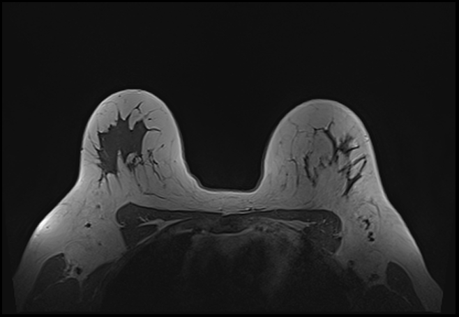 File:Normal breast MRI - dense breasts (Radiopaedia 80454-93850 Axial T1 158).jpg