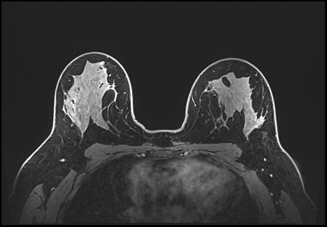 Normal breast MRI - dense breasts (Radiopaedia 80454-93850 C 135).jpg