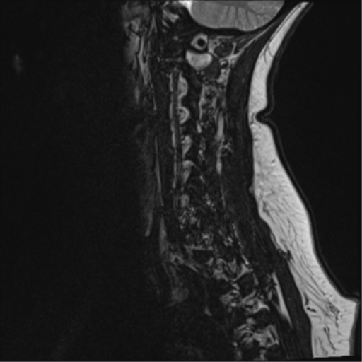 File:Normal cervical spine MRI (including Dixon) (Radiopaedia 42762-45925 Dixon- opposed phase 3).png