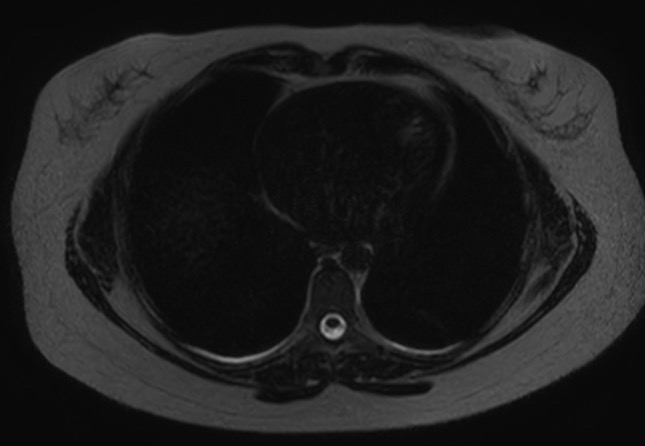 File:Normal liver MRI with Gadolinium (Radiopaedia 58913-66163 E 33).jpg