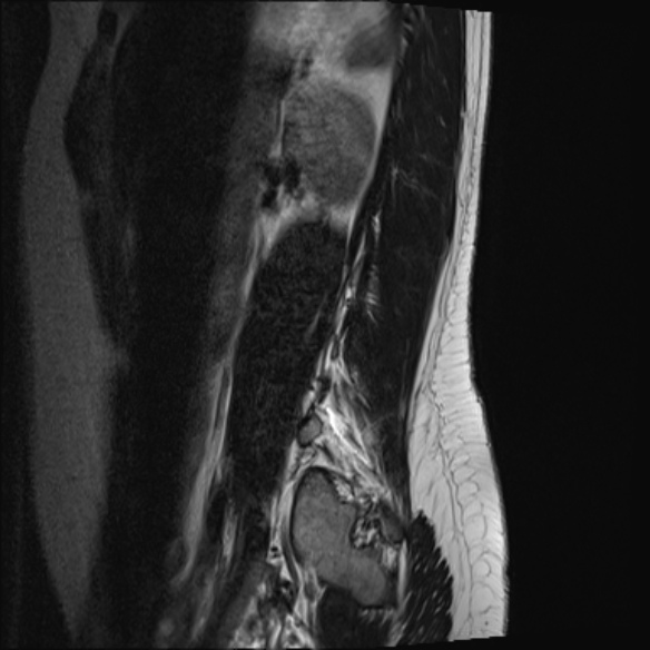 File:Normal lumbar spine MRI- 3 T (Radiopaedia 53280-59250 Sagittal T2 23).jpg