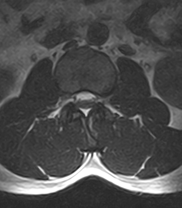 Normal lumbar spine MRI - low-field MRI scanner (Radiopaedia 40976-43699 Axial T2 35).jpg