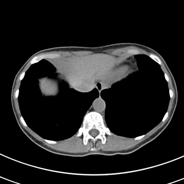 File:Normal multiphase CT liver (Radiopaedia 38026-39996 Axial non-contrast 5).jpg