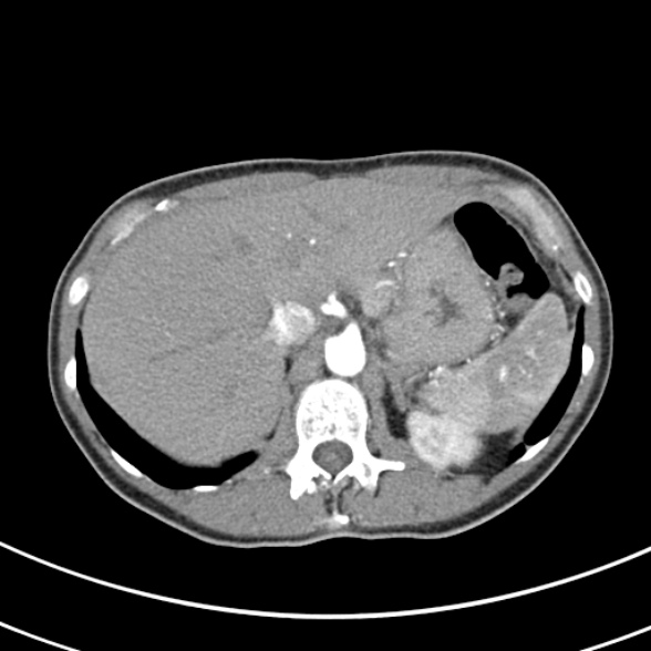 File:Normal multiphase CT liver (Radiopaedia 38026-39996 B 17).jpg