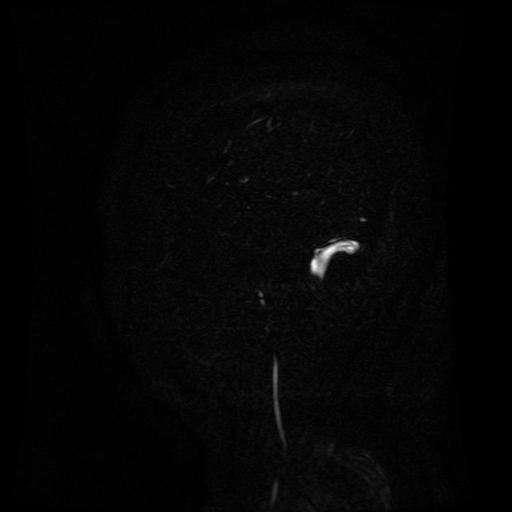 Normal noncontrast MR venography (Radiopaedia 87578-103957 A 153).jpg