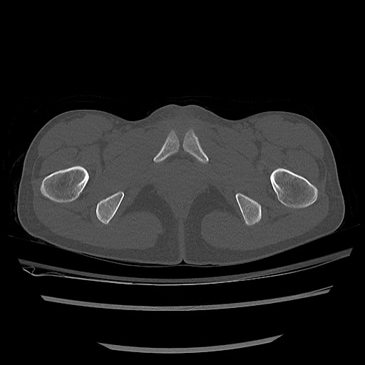 Normal pelvis CT (Radiopaedia 51471-57236 Axial bone window 92).jpg