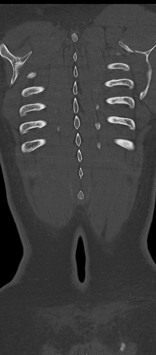 Normal thoracolumbar spine (Radiopaedia 43822-47309 Coronal bone window 84).png