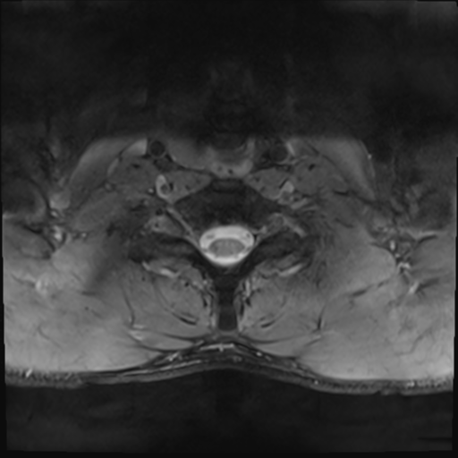 File:Normal trauma cervical spine (Radiopaedia 41017-43762 Axial T2 24).png