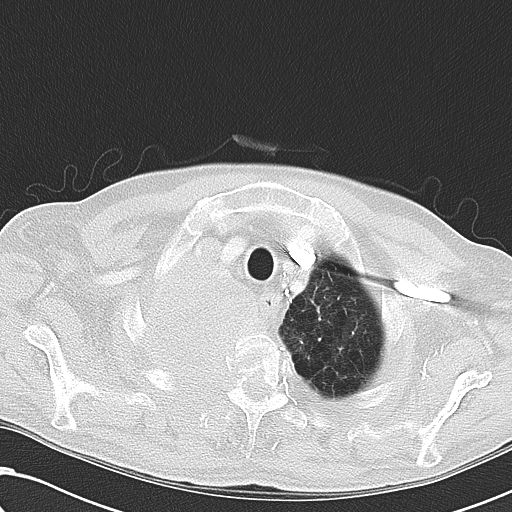 File:Obstructive superior vena cava tumor thrombus (Radiopaedia 28046-28306 Axial lung window 8).jpg