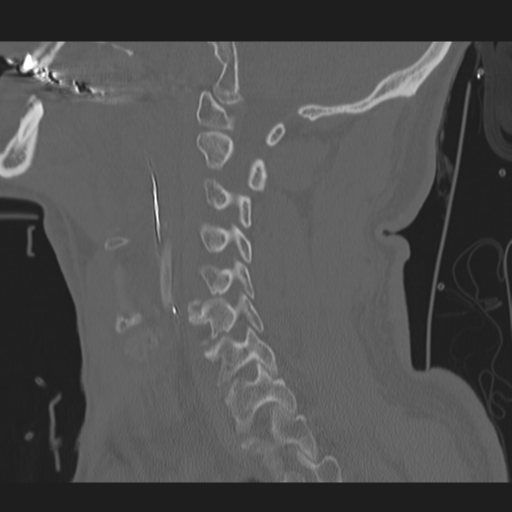 File:Occipital condyle fracture (Radiopaedia 33467-34517 Sagittal bone window 27).png