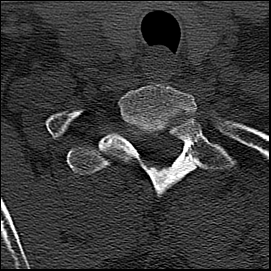 Occipital condyle fracture (type 1) (Radiopaedia 87670-104084 Axial bone window 81).jpg