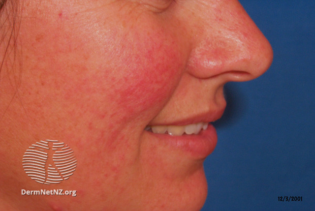 Rosacea (DermNet NZ acne-red-face-3615).jpg