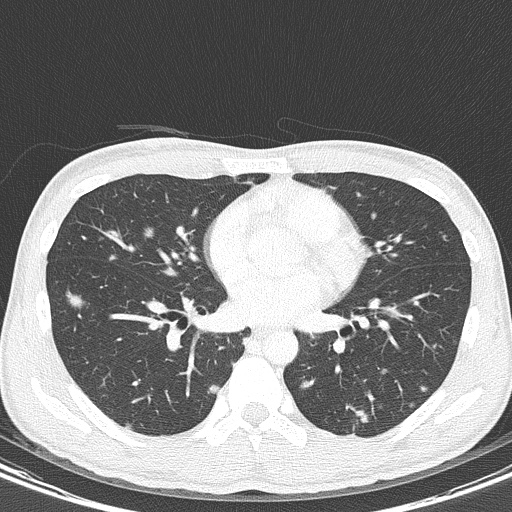 AIDS-related Kaposi sarcoma (Radiopaedia 85247-100811 Axial lung window 97).jpg