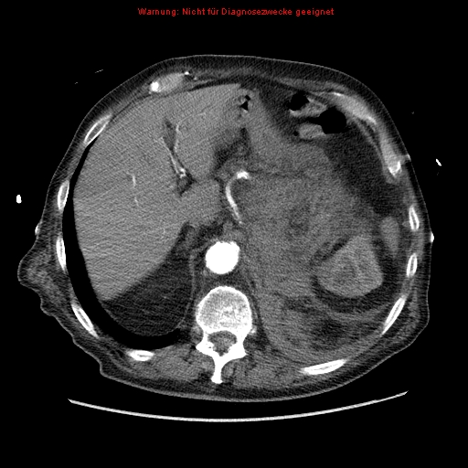 Abdominal aortic aneurysm- extremely large, ruptured (Radiopaedia 19882-19921 Axial C+ arterial phase 15).jpg