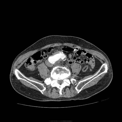 File:Abdominal aortic aneurysm (Radiopaedia 13341-13340 Axial C+ arterial phase 155).jpg