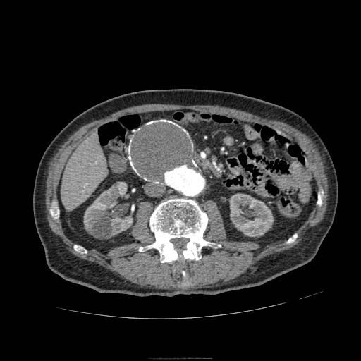 Abdominal aortic aneurysm (Radiopaedia 13341-13340 Axial C+ arterial phase 92).jpg
