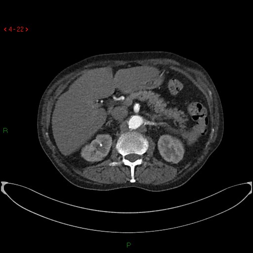 File:Abdominal aortic aneurysm (Radiopaedia 16155-15834 Axial C+ arterial phase 2).jpg