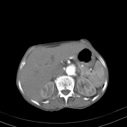 File:Abdominal aortic aneurysm (Radiopaedia 20827-20742 Axial C+ arterial phase 10).jpg