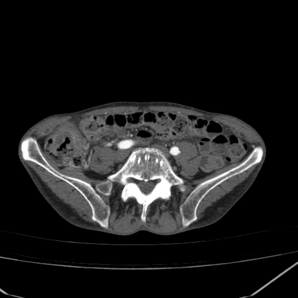 Abdominal aortic aneurysm (Radiopaedia 23703-23856 Axial C+ arterial phase 65).jpg