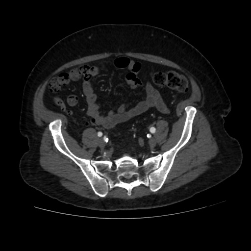 File:Abdominal aortic aneurysm (Radiopaedia 57318-64259 Axial C+ arterial phase 56).jpg