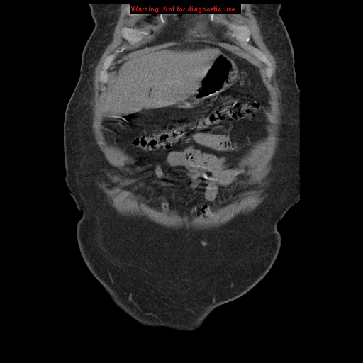 Abdominal aortic aneurysm (Radiopaedia 8190-9038 Coronal C+ arterial phase 19).jpg