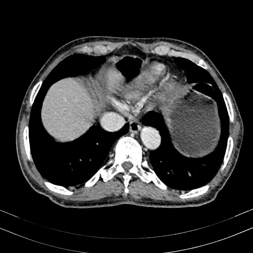 Abdominal aortic aneurysm (Radiopaedia 83581-98689 Axial C+ portal venous phase 11).jpg