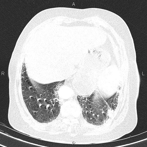 File:Abdominal aortic aneurysm (Radiopaedia 85063-100606 Axial lung window 53).jpg