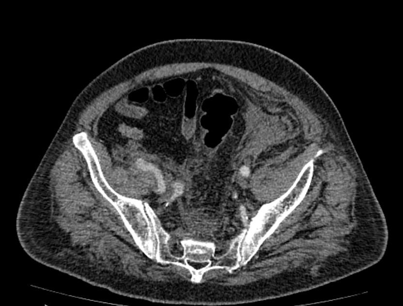 Abdominal aortic aneurysm rupture (Radiopaedia 54179-60362 Axial C+ arterial phase 47).jpg
