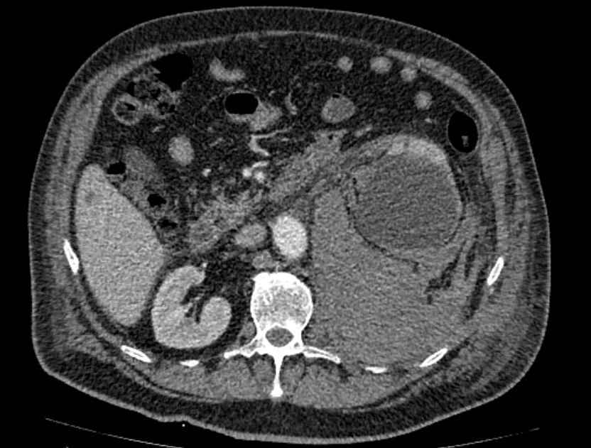 Abdominal aortic aneurysm rupture (Radiopaedia 54179-60362 Axial C+ portal venous phase 24).jpg