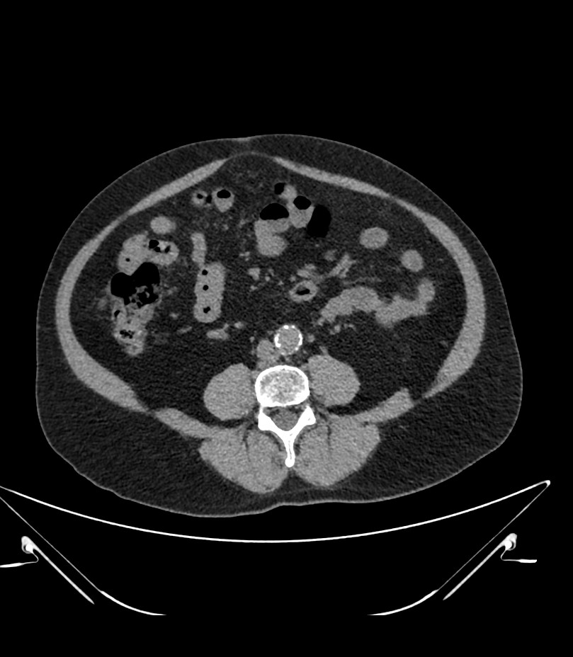 Abdominal aortic aneurysm with thrombus fissuration (Radiopaedia 46218-50618 Axial non-contrast 32).jpg