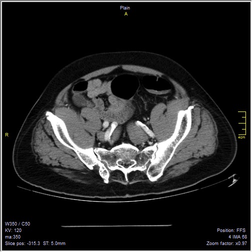 Abdominal aortic aneurysm with thrombus fissuration (Radiopaedia 47340-51926 Axial C+ arterial phase 52).jpg